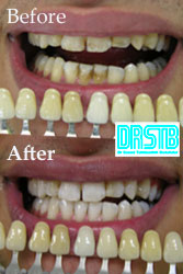 drstb-bleaching